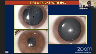 Dr Ramamurthy D - Tips & Tricks with IPCL - Schwind IPCL Users Meet
