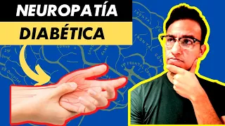 NEUROPATÍA DIABÉTICA: ardor, molestia y debilidad por daño en nervios