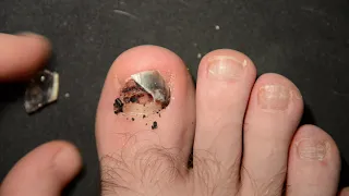 So you dropped a Maglite flashlight onto your toe. Timelapse of the nail falling off.