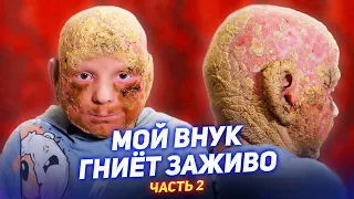 Мой внук ГНИËТ ЗАЖИВО / "ЧЕШУЯ" вместо кожи / Синдром KID, Ихтиоз / Часть 2 [Добрый Волшебник]