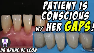 Closing The Patient's Gaps with Direct Composite Technique #C24