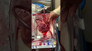 Американские хирурги оживили сердце мертвого пациента