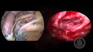 EEA Cavernous Sinus Dermoid Cyst