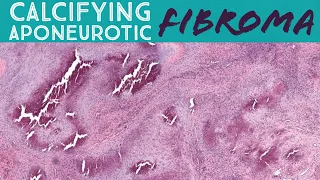 Calcifying Aponeurotic Fibroma (UNC Case 5) (pathology, dermatopathology, soft tissue tumor)