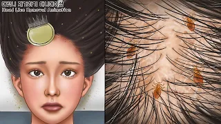 ASMR Creepy! Cool removal of tickled head lice | seborrheic dermatitis treatment