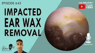 643 - Impacted Ear Wax Removal