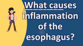 What causes inflammation of the esophagus ? |Healthy Living FAQs