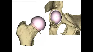 Ceramic on Ceramic Hip Resurfacing