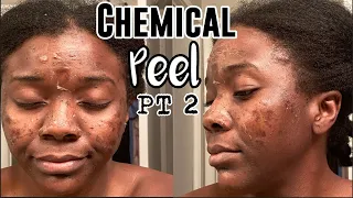 CHEMICAL PEEL FOR HYPERPIGMENTATION | Dark Spot Remover for Face & Peeling Process PT 2