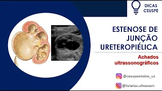 Hidronefrose fetal por estenose de JUP: achados ultrassonográficos