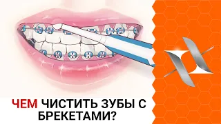 ЧЕМ ЧИСТИТЬ ЗУБЫ С БРЕКЕТАМИ | Где купить? Что выбрать?