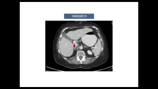 The Role of Immunotherapy in Non Small Cell Lung Cancer NSCLC