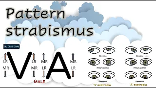 Pattern strabismus │A-V phenomena