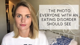 The Photo Everyone with an Eating Disorder Should See (WARNING: GRAPHIC IMAGE)