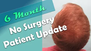 Hair Loss Treatment for Men - without Surgery