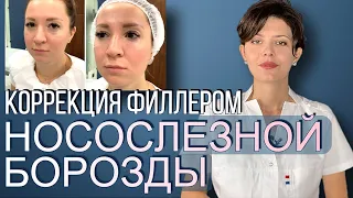 Коррекция Филлером НОСОСЛЕЗНОЙ БОРОЗДЫ 💦👃 ФИЛЛЕР под Глаза 👀 Как убрать НОСОСЛЕЗНУЮ БОРОЗДУ