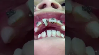 Orthodontist Reacts! INSANE Rotated Tooth! #Shorts