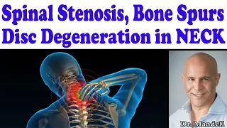 Best Strategies for Cervical (Neck) Spinal Stenosis, Disc Degeneration, Bone Spurs - Dr Mandell, DC