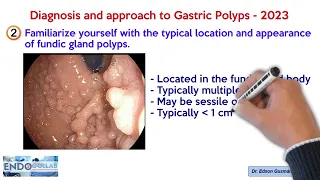 Diagnosis and approach to gastric polyps - 2023