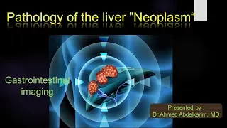 2-Hepatic neoplasm (focal lesion)