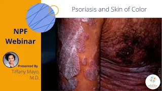 Psoriasis and Skin of Color