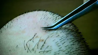 Facial hair removal with tweezers 6. ピンセットを使った顔の毛抜き