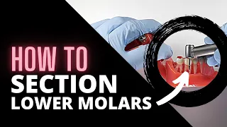 Tips For Sectioning Mandibular Molars | OnlineExodontia.com