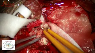 TUBERCULOMA OF THE BRAIN - MICROSURGICAL EXCISION