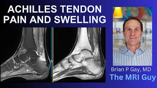 Achilles tendon pain