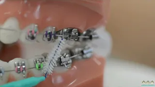 How to use interdental brushes on braces | Evolution Orthodontics
