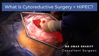 Cytoreductive Surgery + HIPEC: What is it?