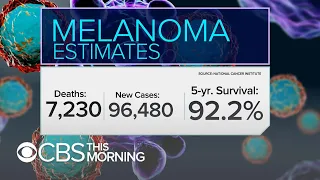 Melanoma Monday: Survival rates improving due to treatment advances