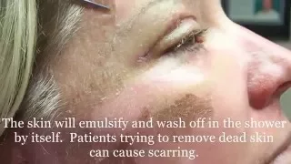 Peeling Skin  from 30% TCA peel