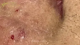 🥰Hope  with blackheads removal/Pimple  popping/Acne treatment #huang #@nandy9649