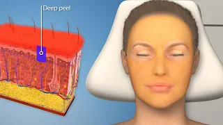 Deep Chemical Peel: The most powerful and dangerous skin treatment you can get