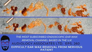 DIFFICULT EAR WAX REMOVAL FROM NERVOUS PATIENT - EP 260