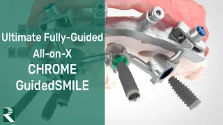 Ultimate Fully-Guided All-on-X: CHROME GuidedSMILE Full Arch