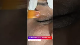 Take Advantage Of Chemical Peel | Viral #shorts