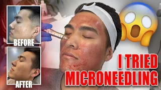 Before and After 3 Microneedling Sessions!