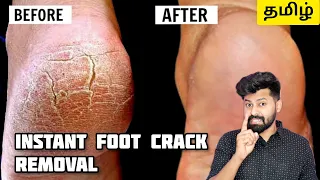 Instantly Remove Foot Cracks | Tamil | English Subtitles | Shadhik Azeez