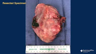 Robot Resection: Solitary Fibrous Tumor