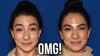 BOTOX BEFORE AND AFTER