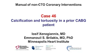 Case 46: PCI Manual - Calcification + tortuosity in prior CABG patient