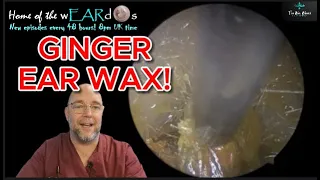 GINGER EAR WAX! 260 #ear #earwax #earwaxremoval #earcleaning #foryou  #fyp  #asmrearwax #satisfying