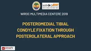 Posteromedial Tibial Condyle Fixation through Posterolateral Approach