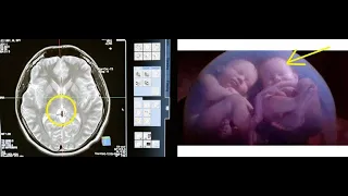 woman's X ray reveals unborn twin inside her brain  at the age of 26