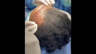 African American Female FUT Hair Transplant