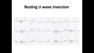 ECG course: Resting U wave inversion in NSTE-ACS, Dr. Sherif Altoukhy