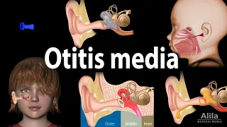 Otitis Media: Anatomy, Pathophysiology, Risk Factors, Types of OM, Symptoms and Treatment, Animation