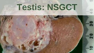 Testicular germ cell tumours  - Non seminomatous germ cell tumours - Pathology mini tutorial